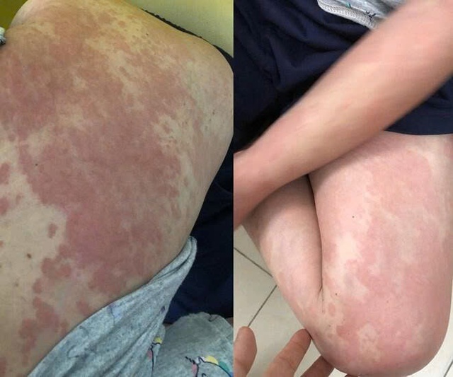 Rước bệnh sau khi đi bơi giải nhiệt m&ugrave;a n&oacute;ng, chuy&ecirc;n gia chỉ r&otilde; "thủ phạm"- Ảnh 1.
