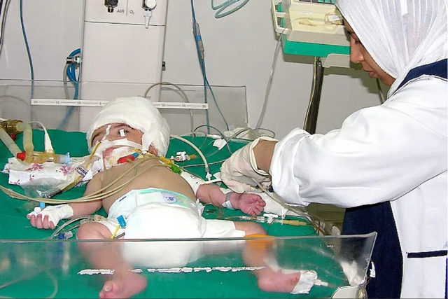 Bé gái sinh ra với 2 khuôn mặt trên cùng một đầu, ca y khoa ám ảnh nhất lịch sử - Ảnh 2.