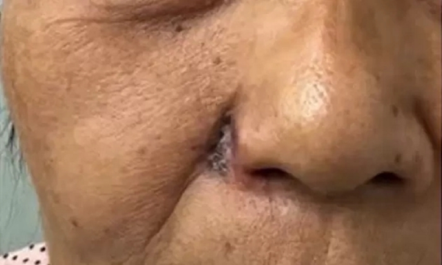 Nốt ruồi đổi m&agrave;u bất thường, người phụ nữ "sốc" khi ph&aacute;t hiện căn bệnh n&agrave;y- Ảnh 1.