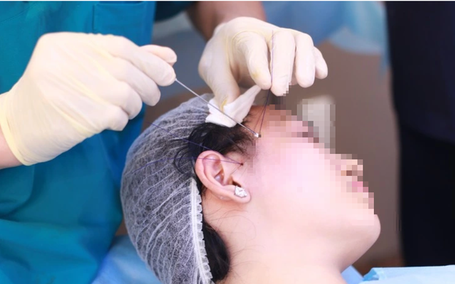 Trào lưu tự căng da mặt tại nhà gây sốc: Nhiều cô gái đối mặt nguy cơ hủy hoại gương mặt - Ảnh 1.