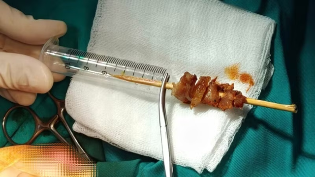 Chạy nhảy, bé gái 2 tuổi bị que xiên thịt đâm sâu suýt xuyên sọ não - Ảnh 1.
