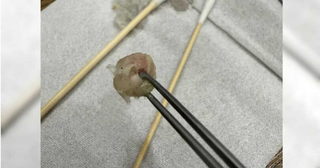 B&eacute; g&aacute;i 6 tuổi đau khổ v&igrave; nghẹt mũi, sự thật b&ecirc;n trong khiến bố mẹ "hoảng sợ" - Ảnh 1.