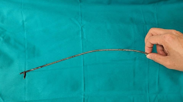 Nhập viện vì đau bất thường, nam bệnh nhân 27 tuổi khiến bác sĩ "sốc" khi lấy ra thứ không ngờ tới - Ảnh 2.