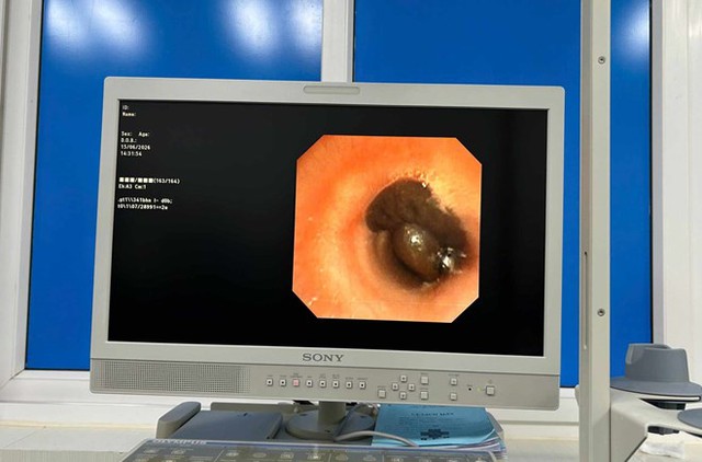 Bé bị ho nhiều, khó thở, bố mẹ sốc khi bác sĩ gắp ra thứ "đáng sợ" trong khí quản - Ảnh 1.