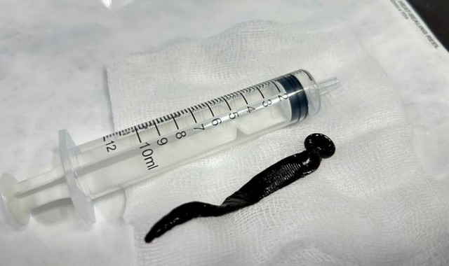 Bé bị ho nhiều, khó thở, bố mẹ sốc khi bác sĩ gắp ra thứ "đáng sợ" trong khí quản - Ảnh 2.