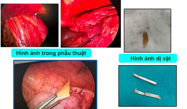 Bé 4 tuổi đau bụng dữ dội, bố mẹ "sốc nặng" khi bác sĩ lấy ra thứ khó tin trong bụng - Ảnh 1.