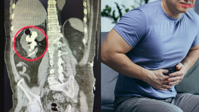 Người đ&agrave;n &ocirc;ng 51 tuổi "thận sỏi như san h&ocirc;" v&igrave; uống thứ nước quen thuộc nhiều người m&ecirc; - Ảnh 1.
