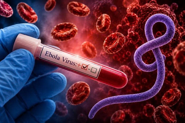 B&aacute;c sĩ cảnh b&aacute;o triệu chứng của Ebola dễ bị bỏ qua- Ảnh 2.