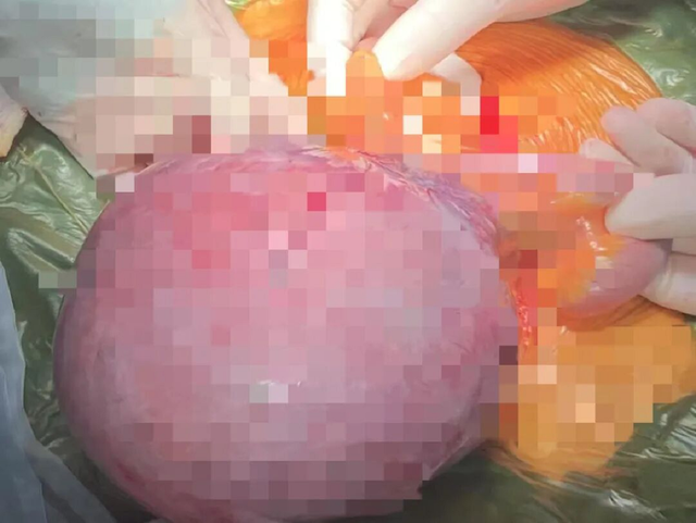Bé trai 9 tuổi đau bụng suốt 1 năm, bố mẹ sốc khi bác sĩ lấy ra thứ "đáng sợ" bên trong- Ảnh 2.