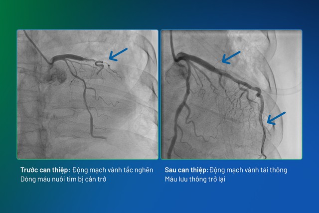Cứu sống bệnh nh&acirc;n nhồi m&aacute;u cơ tim cấp giữa "ma trận" bệnh l&yacute; phức tạp - Ảnh 2.
