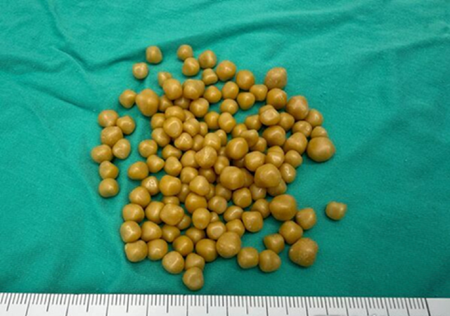 Đau bụng suốt 1 tháng, người phụ nữ 38 số khi bác sĩ lấy ra thứ "đáng sợ" trong cơ thể - Ảnh 1.