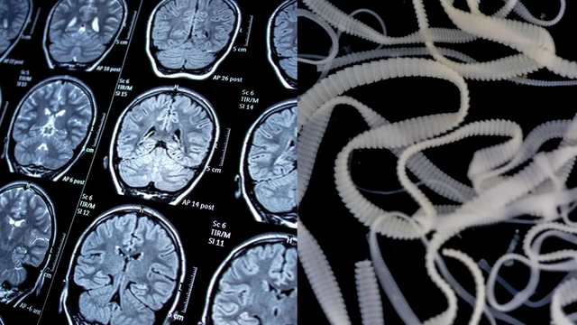 Đi du lịch về, cô gái phát hiện 38 nang sán "đáng sợ" trong não- Ảnh 2.