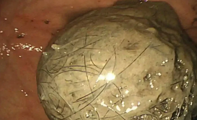 Bé gái 10 tuổi đau bụng suốt 3 năm, bố mẹ sốc khi bác sĩ lấy ra thứ "đáng sợ" trong bụng - Ảnh 1.