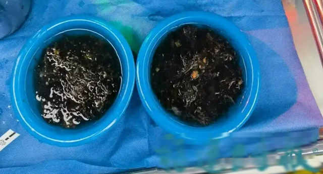 Bé gái 10 tuổi đau bụng suốt 3 năm, bố mẹ sốc khi bác sĩ lấy ra thứ "đáng sợ" trong bụng - Ảnh 2.