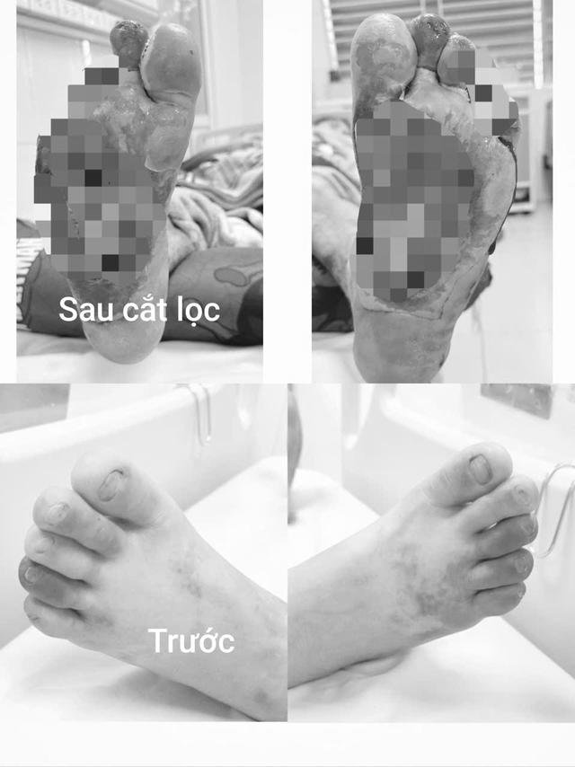 Chủ quan với vết xước nhỏ, người đàn ông phải cắt cụt nhiều ngón chân - Ảnh 1.