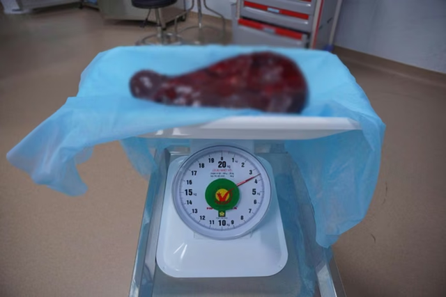 Bụng người đàn ông 69 tuổi ngày càng phình to, bác sĩ sững sờ khi phát hiện thứ "khổng lồ" bên trong - Ảnh 1.