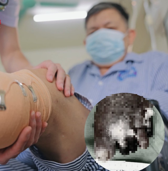 Nghe lời truyền miệng, ngâm chân nước trà xanh nóng, người đàn ông 66 tuổi phải cắt cụt chân - Ảnh 1.