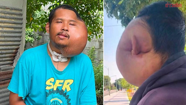 Xỉa răng sai cách, người đàn ông 31 tuổi có khuôn mặt "đáng sợ" - Ảnh 1.
