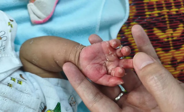 Xuất hiện dấu hiệu lạ ở da, bé 2 tháng tuổi mắc bệnh ít ai ngờ - Ảnh 1.