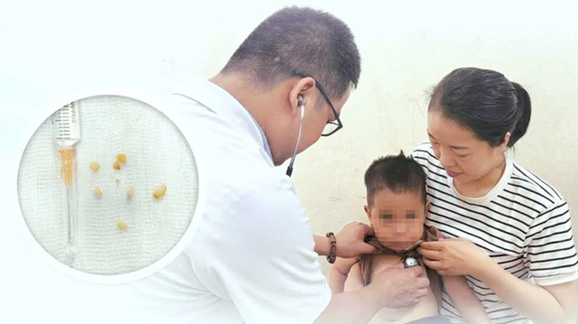 Bé trai 2 tuổi ho sặc dữ dội, tím tái sau ăn lạc theo cách "vạn người mê" - Ảnh 1.