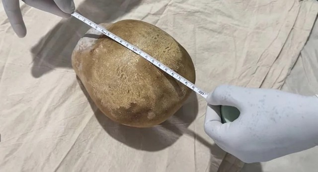 Lấy viên sỏi nặng 3,1kg ra khỏi bàng quang của người đàn ông 55 tuổi - Ảnh 1.
