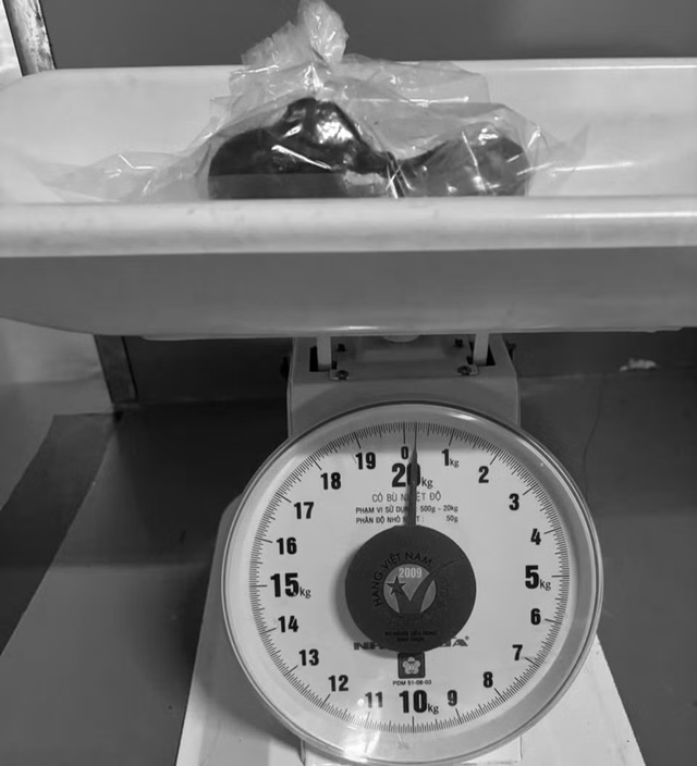 Bé gái 5 tuổi biểu hiện lạ, bác sĩ gắp ra thứ "đáng sợ" trong bụng - Ảnh 1.