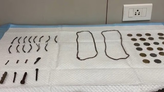 Cậu bé đau bụng rồi nôn mửa, bác sĩ sốc nặng khi lấy ra thứ bên trong - Ảnh 1.