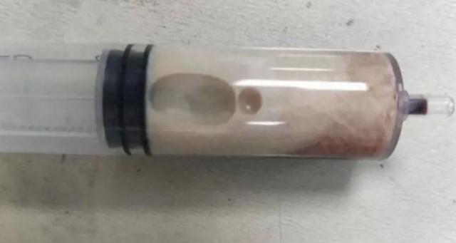 Người đàn ông 32 tuổi máu "trắng đục như sữa" sau khi ăn món thịt quen thuộc - Ảnh 2.