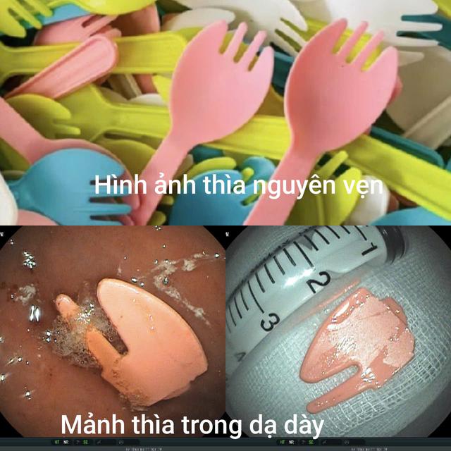 Bé trai 20 tháng tuổi nhập viện cấp cứu vì nuốt phải mảnh thìa nhựa - Ảnh 2.