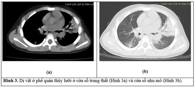 Bé trai 3 tuổi ho suốt một tháng, gia đình sửng sốt khi biết lý do - Ảnh 1.