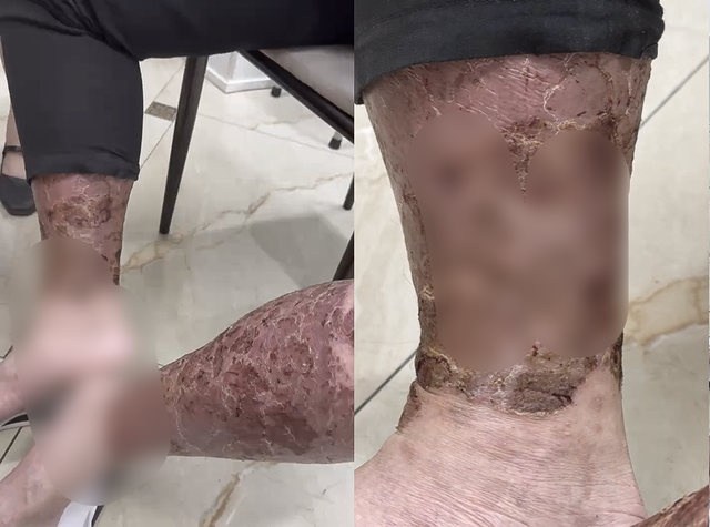 Ngứa kéo dài khiến người bệnh lạm dụng rượu để ngủ, bác sĩ cảnh báo hệ lụy- Ảnh 1.