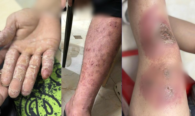 Sau mưa ngập, bác sĩ cảnh báo nguy cơ nhiễm trùng từ bàn chân - Ảnh 1.