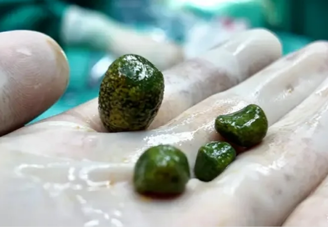Cô gái 28 tuổi "sốc" khi bác sĩ gắp ra thứ "nổi da gà" trong bụng mình- Ảnh 1.