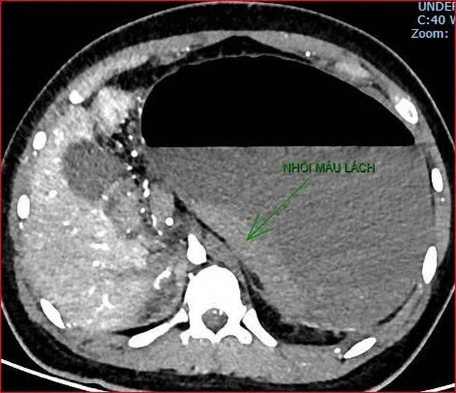 Ca bệnh tử vong g&acirc;y dư luận tr&aacute;i chiều: Bệnh viện th&ocirc;ng tin sự việc- Ảnh 3.