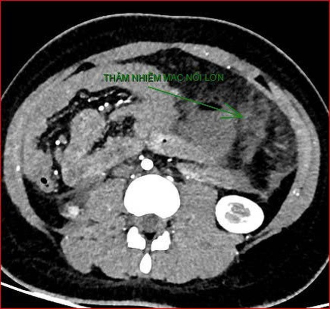Ca bệnh tử vong g&acirc;y dư luận tr&aacute;i chiều: Bệnh viện th&ocirc;ng tin sự việc- Ảnh 2.