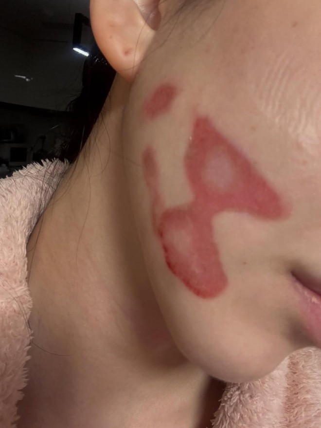 Hậu thẩm mỹ, gương mặt của nữ ca sĩ 33 tuổi bị bỏng nghi&ecirc;m trọng - Ảnh 1.