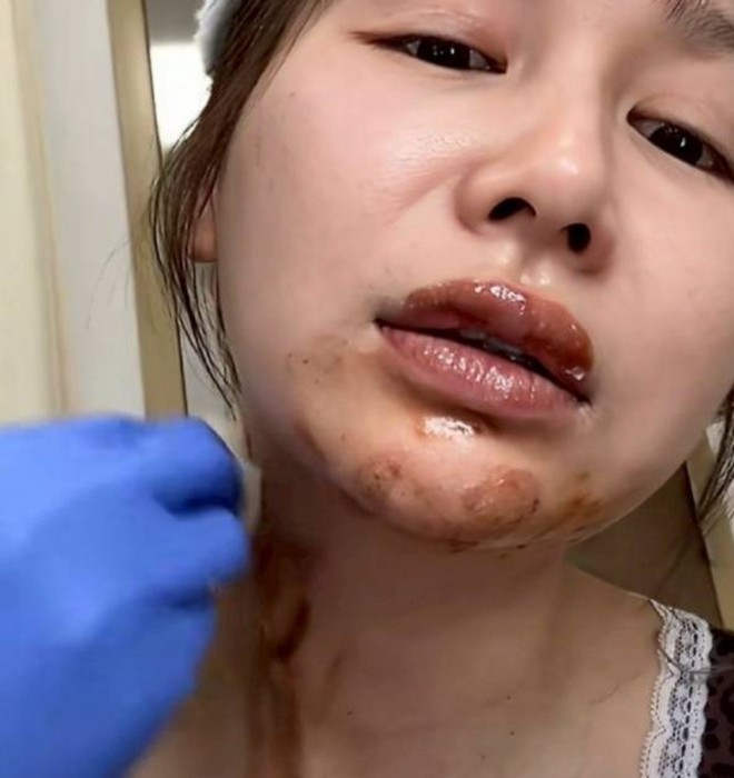 Nữ diễn vi&ecirc;n 27 tuổi bị bỏng nặng v&igrave; bắt trend "b&aacute;nh sinh nhật phun lửa"- Ảnh 4.