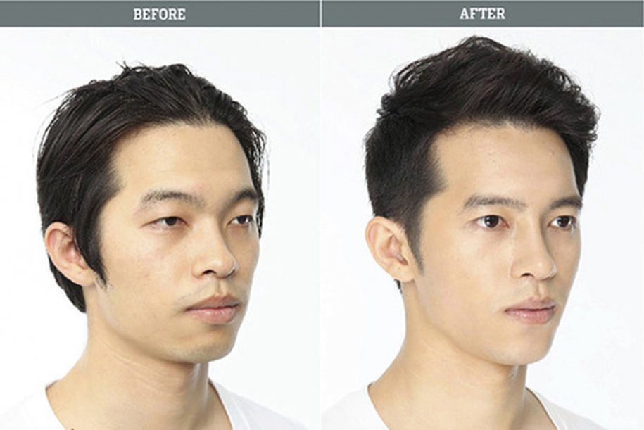 Nam giới có nên phẫu thuật thẩm mỹ?