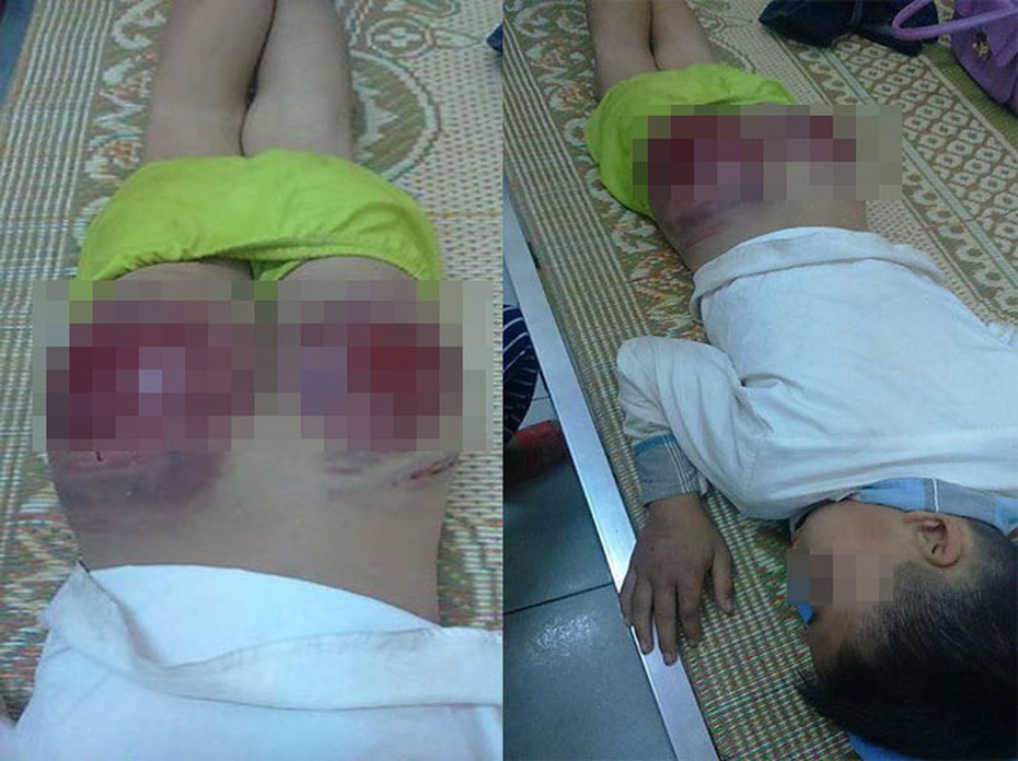 Ông bố đánh con tím mông: 'Xin mọi người đừng nói tôi tàn ác'