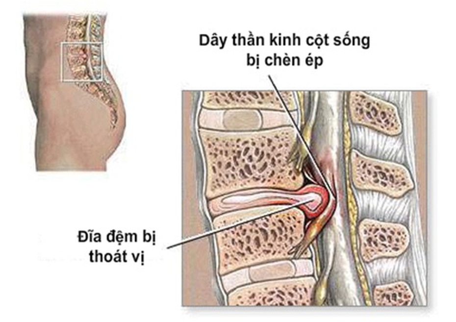 Điều trị thoát vị đĩa đệm cột sống như thế nào?