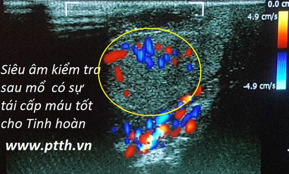 VN lần đầu nối ghép thành công hai tinh hoàn đứt rời cùng dương vật