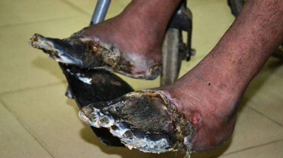 3 thói quen xấu khiến tay chân bị hủy hoại và biến dạng khủng khiếp