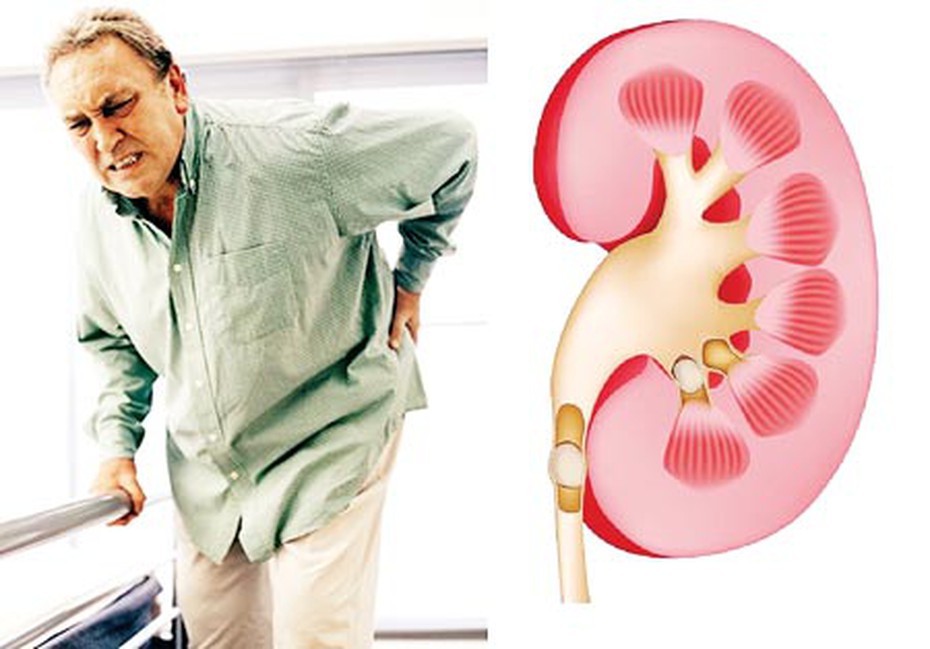 3 bài thuốc hỗ trợ chữa phù thận, suy thận mà ai cũng nên biết