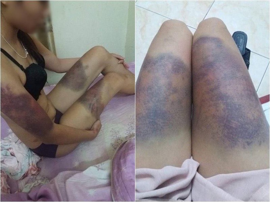 Hà Nội: Lời kể hãi hùng của cô gái bị bạn trai đánh đập dã man
