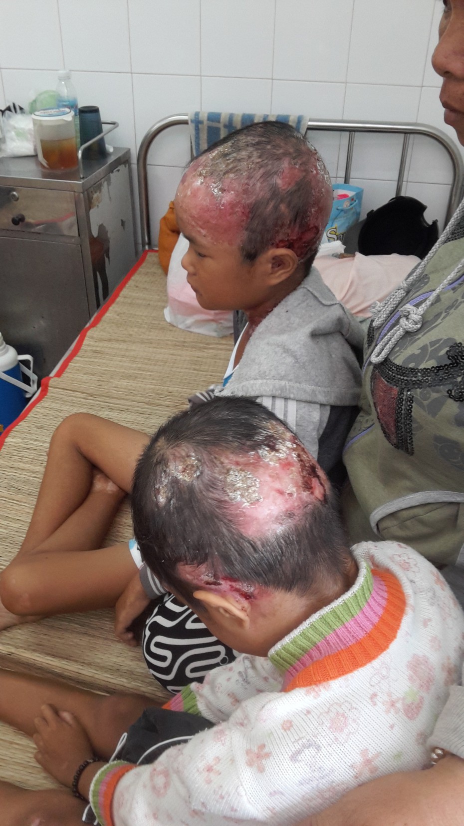 Xót xa hai đứa trẻ trong một gia đình mắc 'bệnh lạ' - da cánh bướm