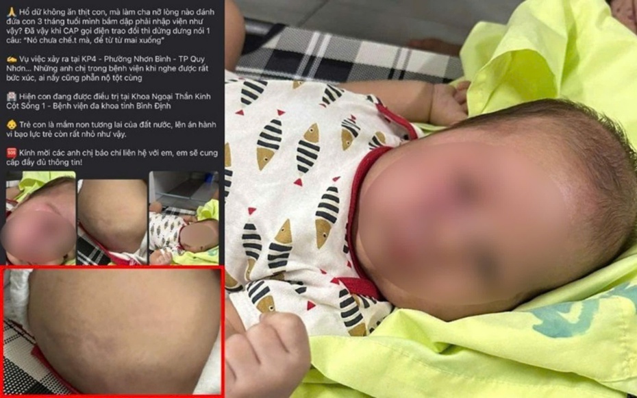 Vụ cháu bé 3 tháng tuổi nhập viện nghi bị bạo hành, công an phường vào cuộc