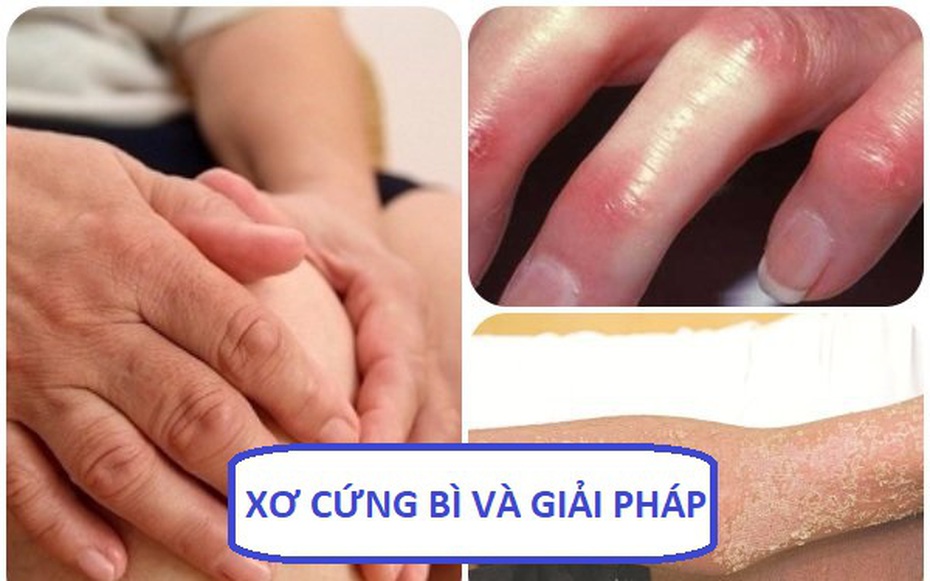 Xơ cứng bì - Căn bệnh khiến da cứng như nhựa và giải pháp