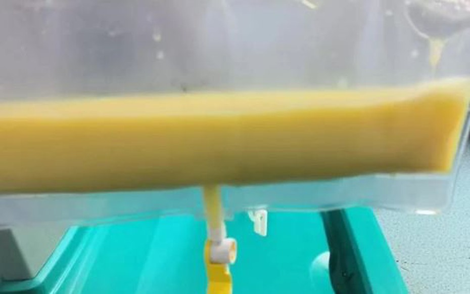 Chàng trai 34 tuổi "máu trắng đục" vì thường xuyên ăn món vạn người mê