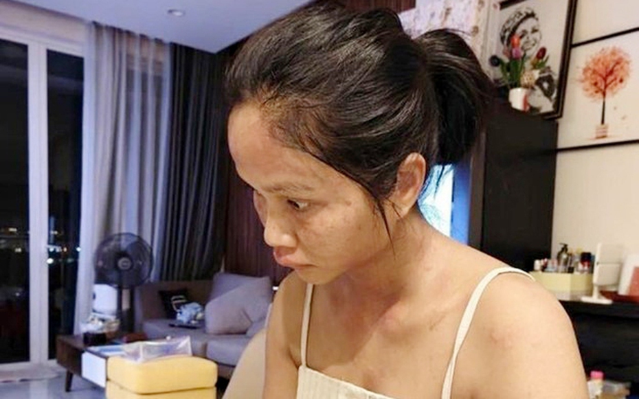 Hoa hậu H'hen Niê tiết lộ căn bệnh mà cô mắc phải sau sinh