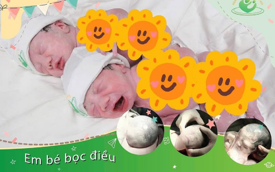 Ca sinh đôi hiếm gặp: Em bé chào đời vẫn còn nguyên vẹn trong "bọc diều"